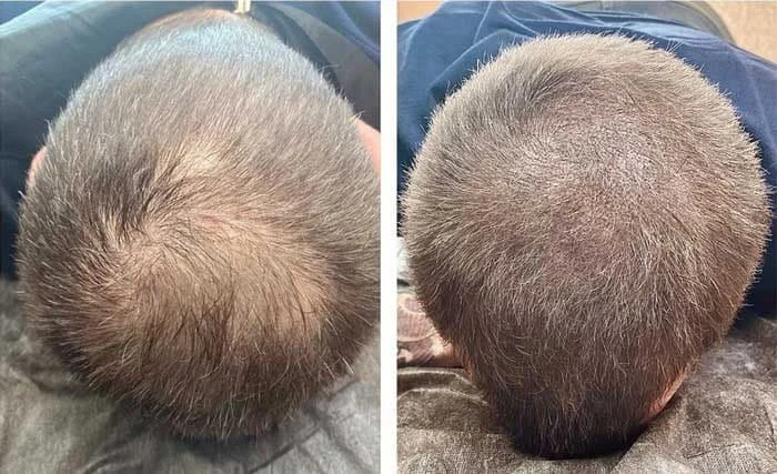 بهترین مرکز کاشت مو در ستارخان کدام است ؟