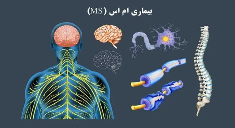 تشخیص و درمان بیماری ام اس