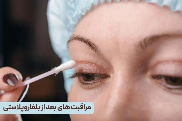 مراقبت های بعد از بفاروپلاستی