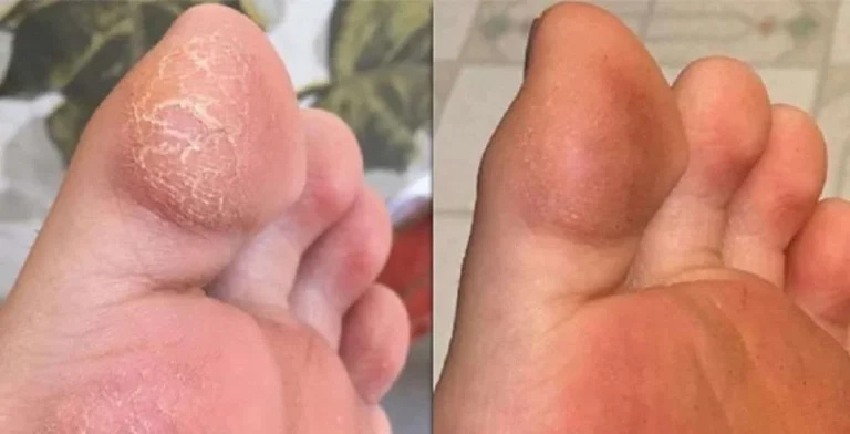 نقش سنگ در جلوگیری از ترک پاشنه پا