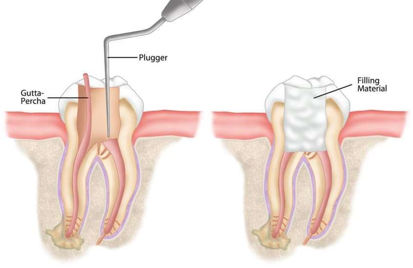  مراحل عصب کشی دندان 