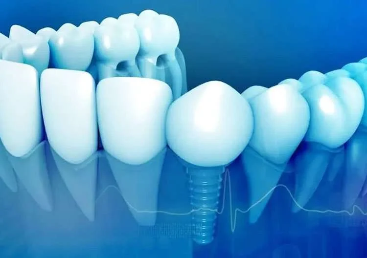  دلایل جلوگیری از کاشت دندان هنگام بارداری 