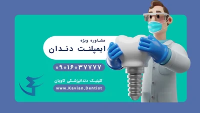  مشاوره رایگان ایمپلنت دندان 