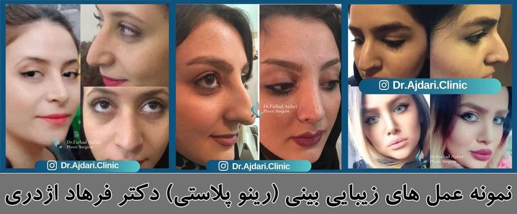 عمل جراحی بینی راینو پلاستی