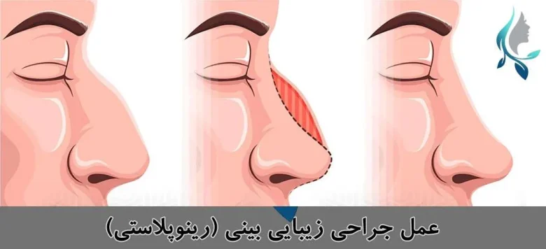 عمل جراحی بینی رینوپلاستی