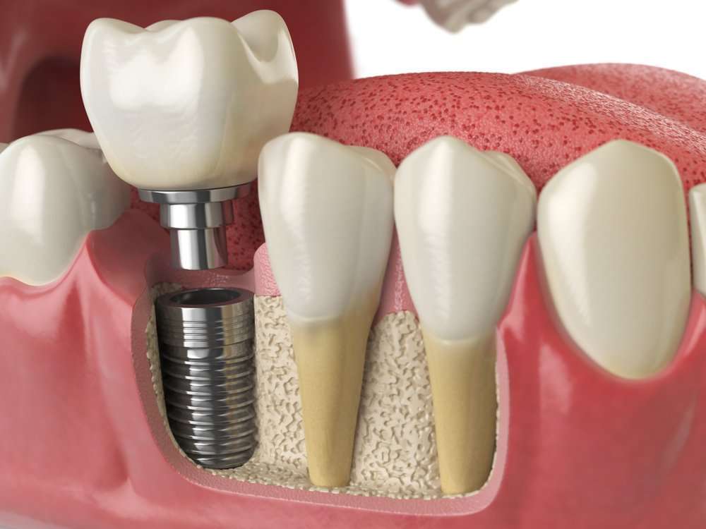  انواع ایمپلنت دندان 