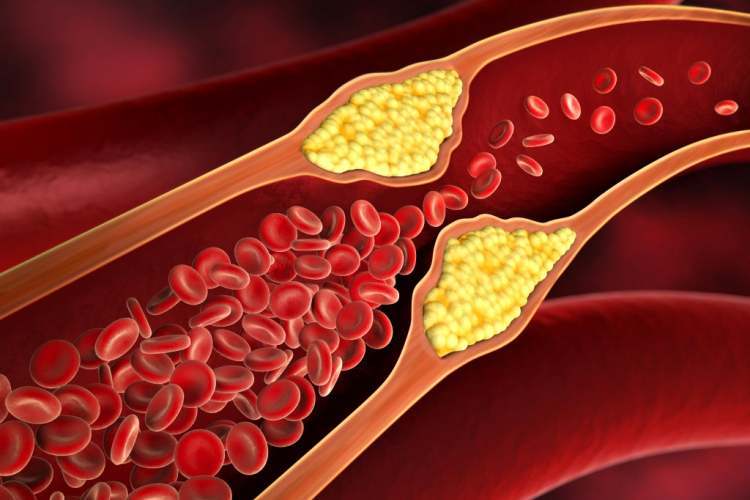 آیا گرفتگی رگ قلب با دارو برطرف میشود