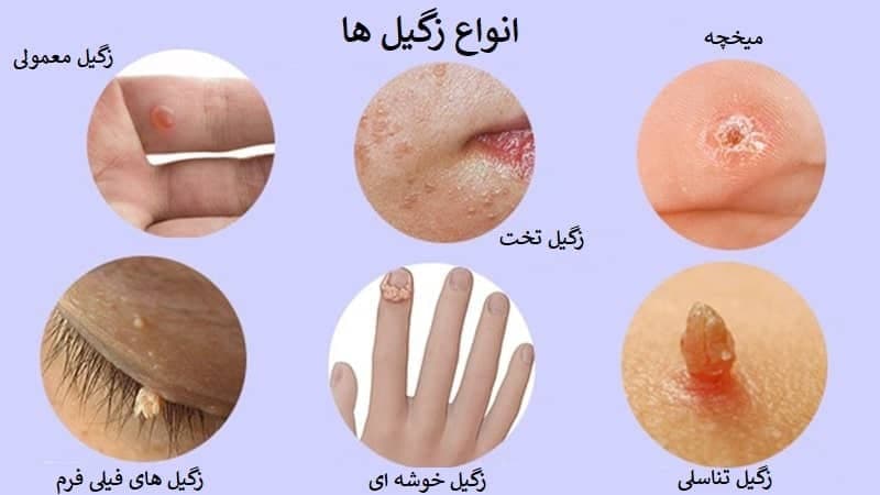 علائم زگیل تناسلی در زنان عکس