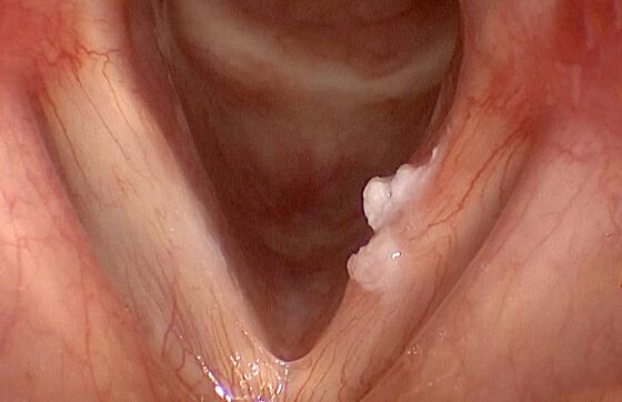 آیا سرطان دهان کشنده است؟, اشکال مختلف سرطان دهان, سرطان دهان