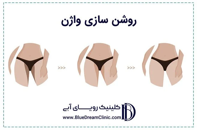  عکس روشن سازی واژن 