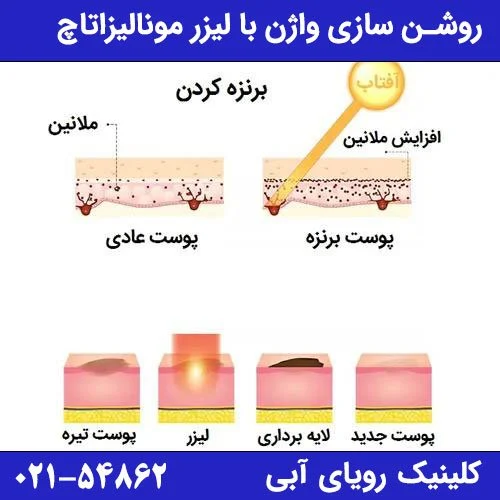  سفید کردن بیکینی با لیزر مونالیزاتاچ کلینیک رویای آبی 