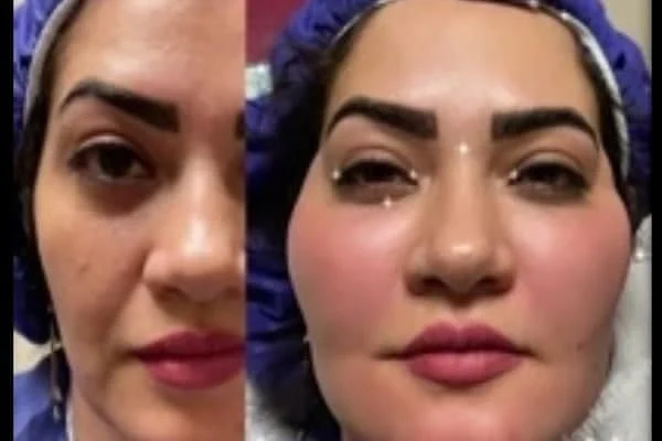 تزریق چربی به صورت چند ساعت طول میکشد