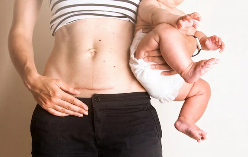 Suture-in-cesarean-surgery