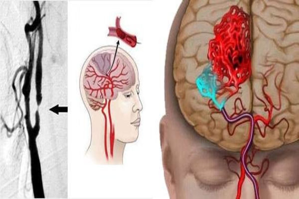 ایا سکته مغزی خوب میشود, طول عمر بعد از سکته مغزی, علائم سکته مغزی خاموش