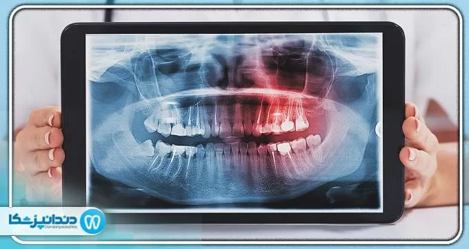  آیا دندان عقل باعث بهم ریختگی همه دندان ها می شود؟ 
