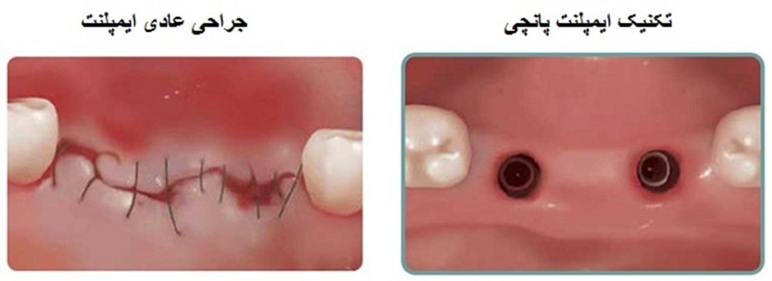 ایمپلنت, ایمپلنت پا, دندانپزشکی