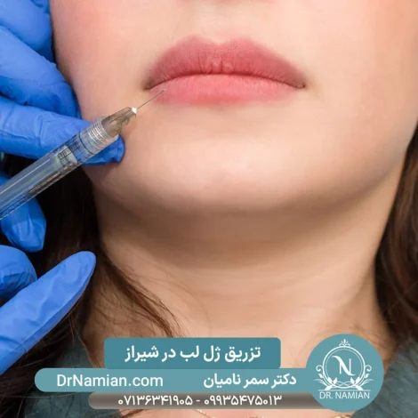 تزریق ژل لب شیراز