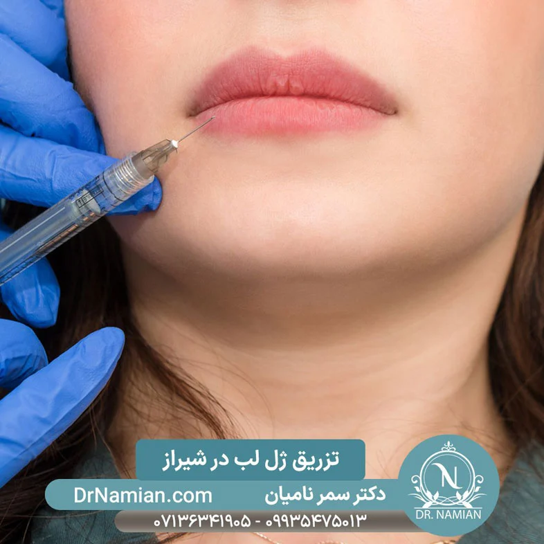 تزریق ژل لب شیراز
