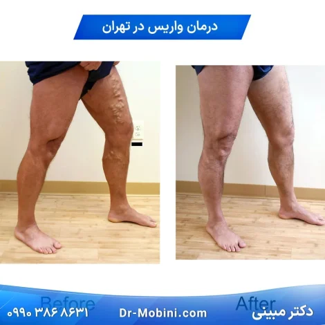 متخصص واریس تهران دکتر مبینی
