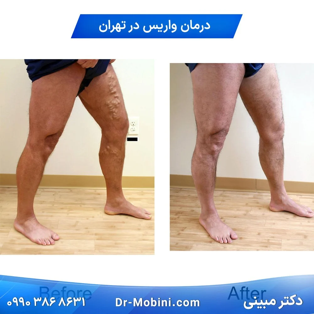 متخصص واریس تهران دکتر مبینی