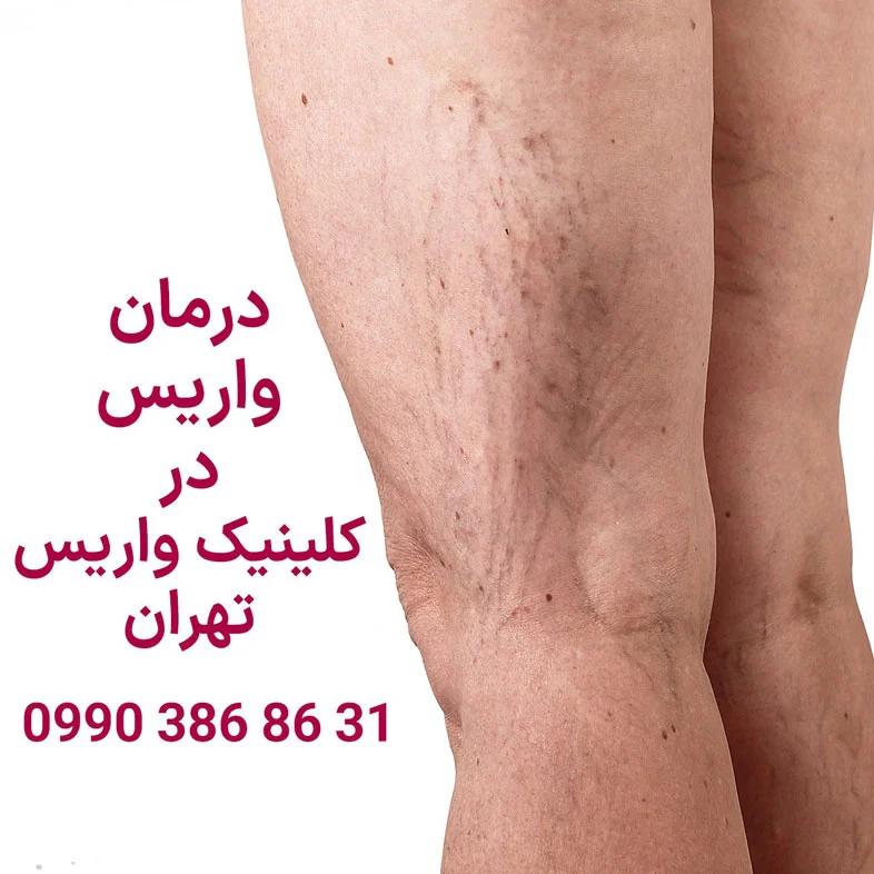 درمان واریس توسط دکتر محمدرضا مبینی