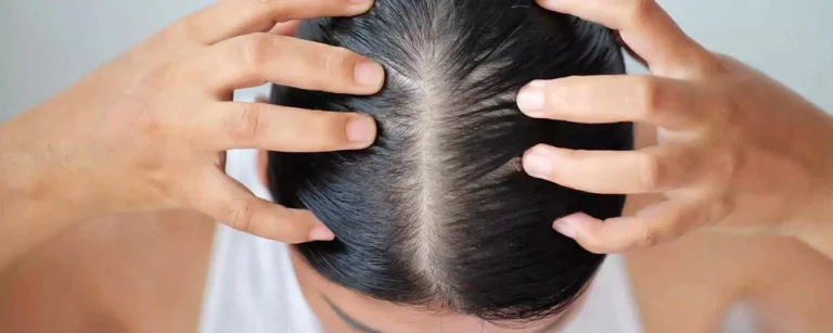 بهترین راهکارها برای درمان ریزش مو
