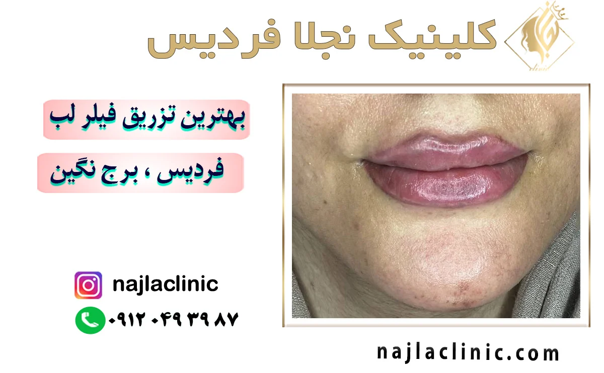 کلینیک تزریق فیلر لب در فردیس