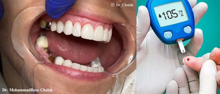 ايمپلنت دندان در افراد ديابتی + معرفی متخصص ایمپلنت دندان مشهد