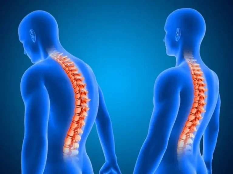 راه های پیشگیری و درمان قوز پشتی