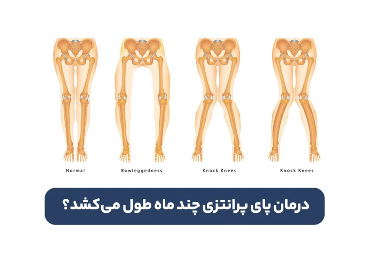 درمان پای پرانتزی چند ماه طول می کشد؟ پاسخ واقعی اینجاست!