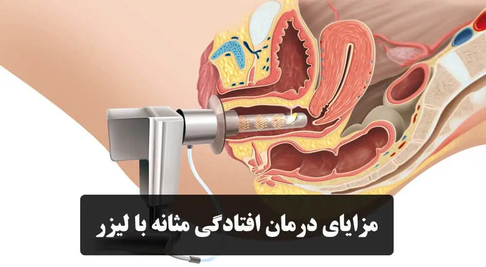 مزایای درمان افتادگی مثانه با لیزر