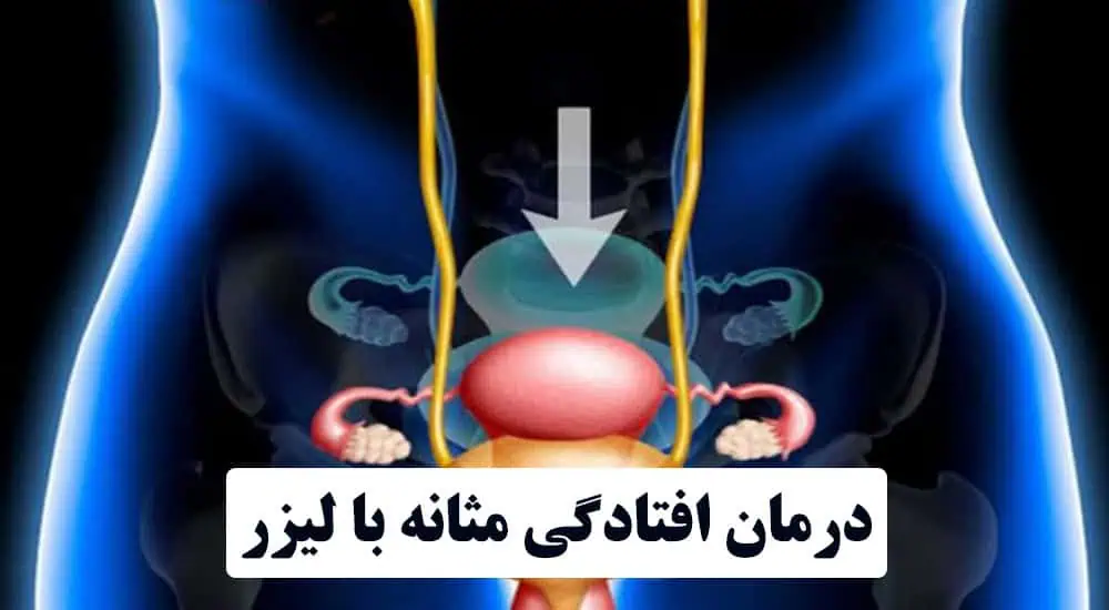 درمان افتادگی مثانه با لیزر، راهی ساده برای بهبود کیفیت زندگی!