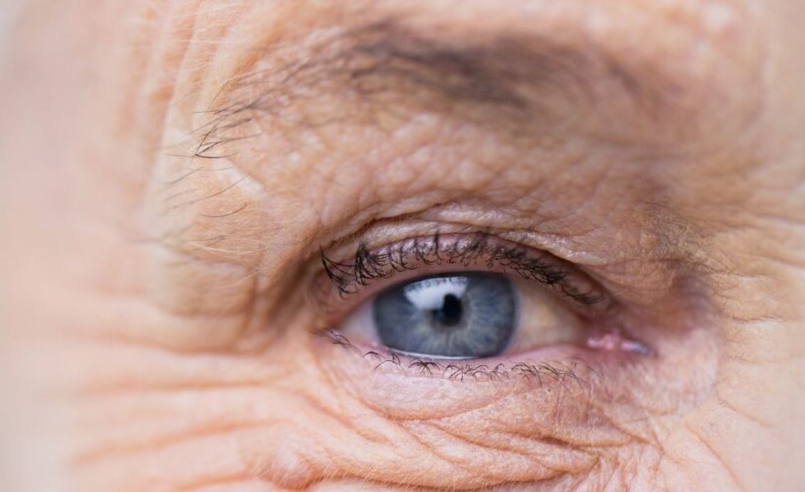تأثیر افتادگی پلک بر بینایی در میانسالی و پیری